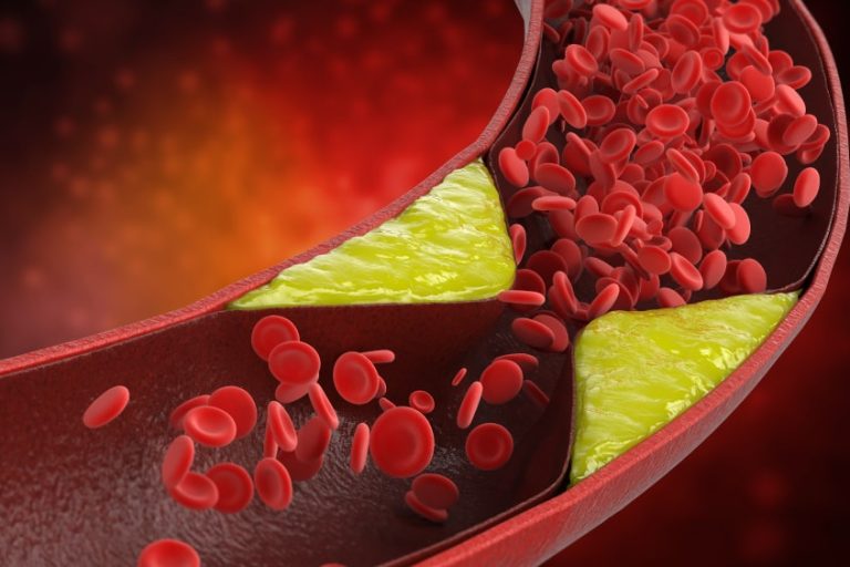 Cholesterol – jak obniżyć jego poziom?